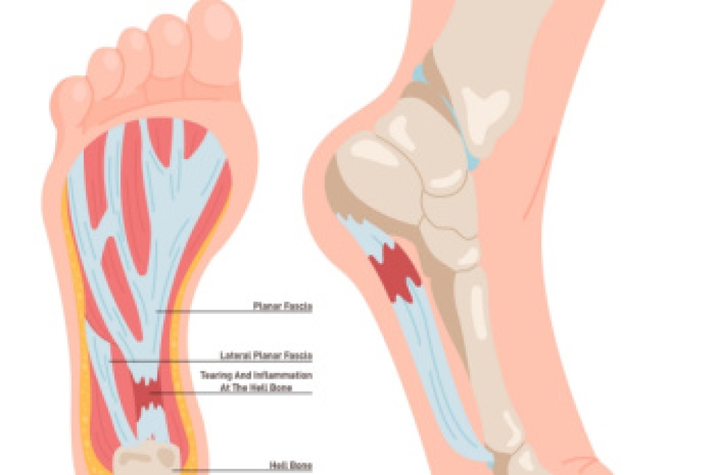 Plantar Fasciitis and Heel Pain