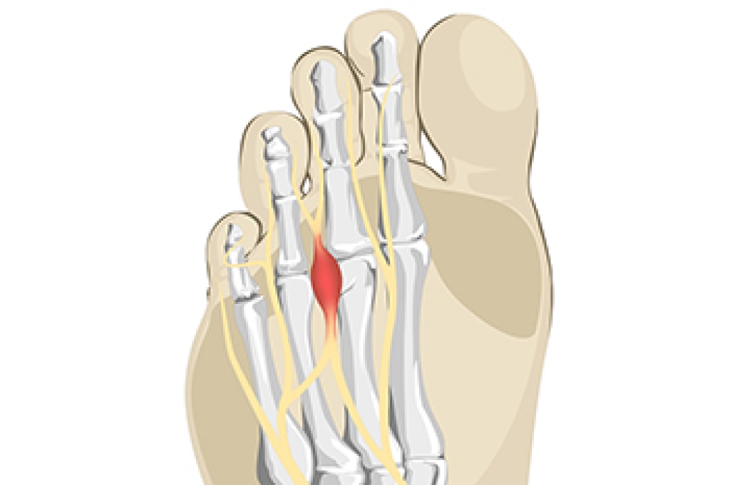 When Nerve Pain Develops Between the Toes