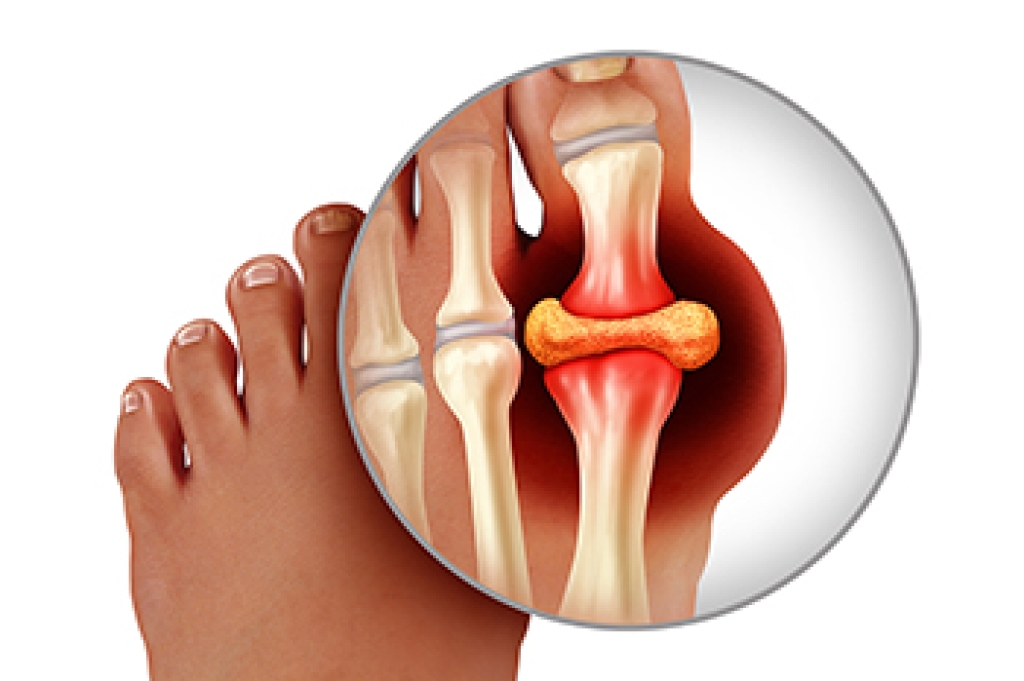 Causes and Risk Factors of Gout