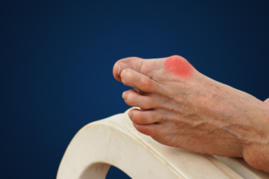 Bunions and How They Affect Foot Structure