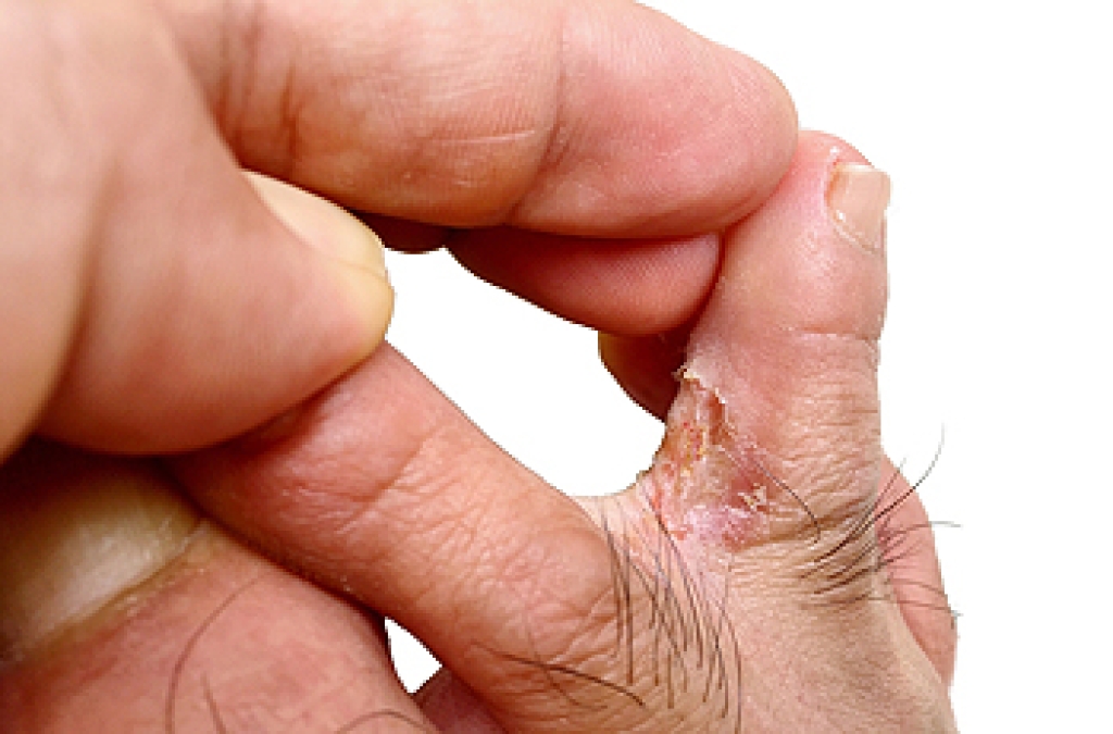 Risk Factors for Athlete’s Foot