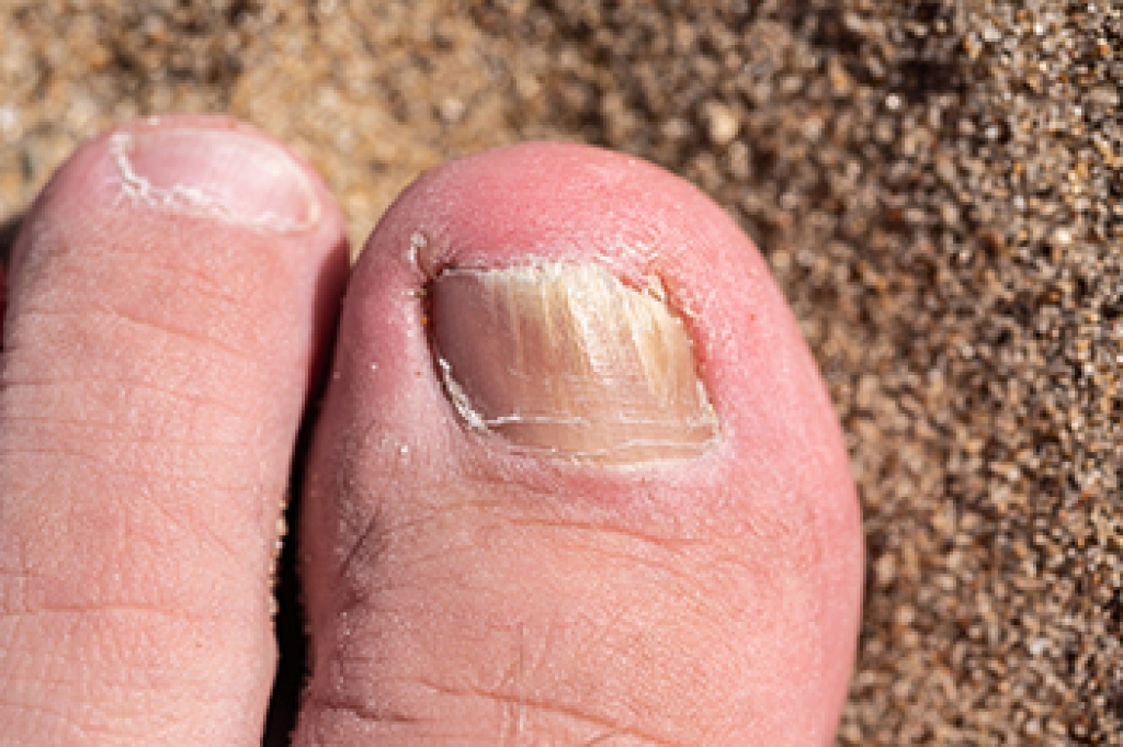 Managing Thick Toenails Caused by Fungal Infections