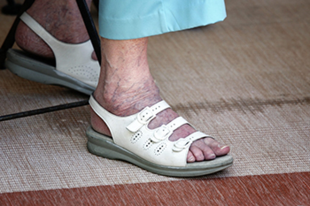 Preventing Foot Problems in Elderly People