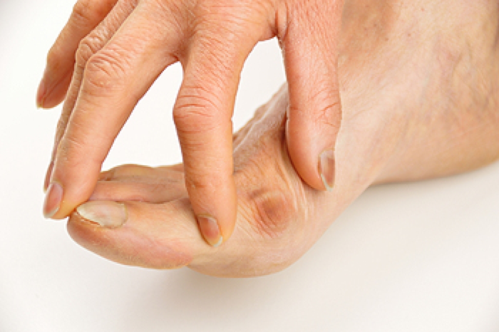 Recognizing Symptoms of a Bunion
