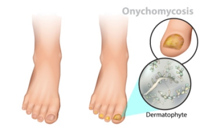 Is Toenail Fungus Caused by Mold or Fungi?