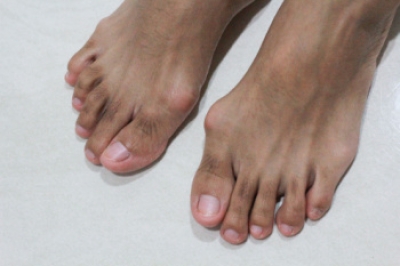 Relieving the Discomfort of Bunions