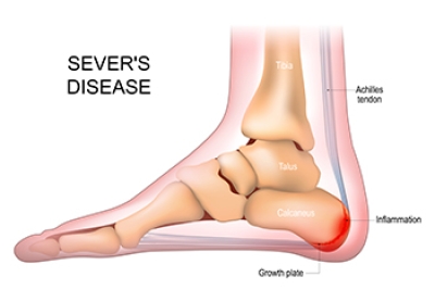 Podiatrist Care for Sever’s Disease
