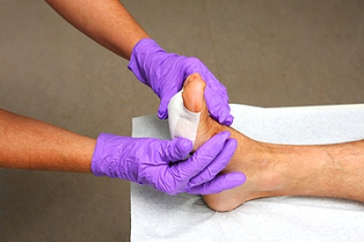 Toe-Sparing Surgery for Neuropathic Ulcers